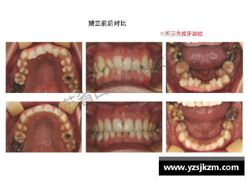 矫正牙齿成功的体育明星：他们如何赢得了笑容和胜利